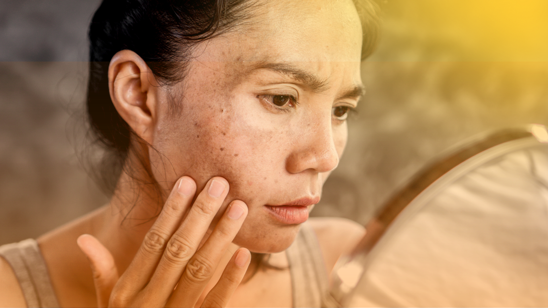 Como o Ayurveda Cura o Melasma: O Caminho Holístico para Tratar a Pigmentação da Pele de Dentro para Fora